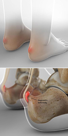 haglund’s deformity