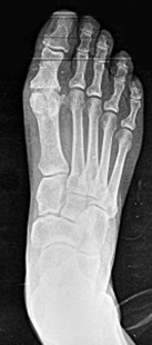 hallux rigidus