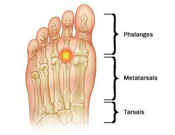 Metatarsalgia