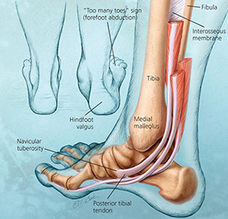 Posterior Tibial Dysfunction