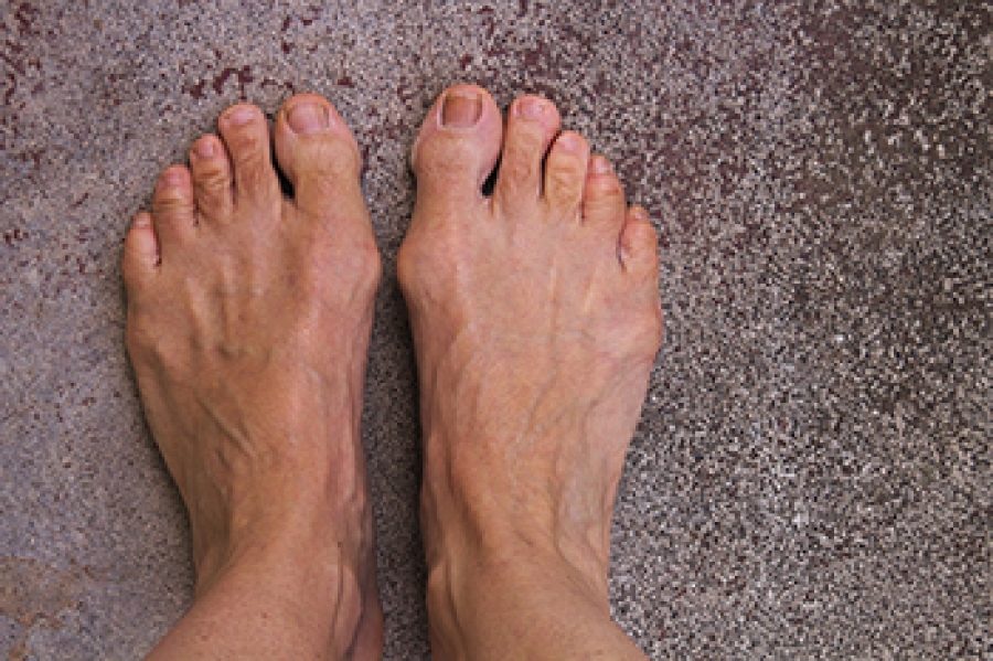 What Can Cause Bunions?