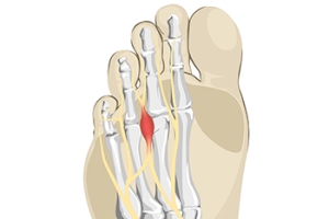 Morton’s Neuroma Remedies