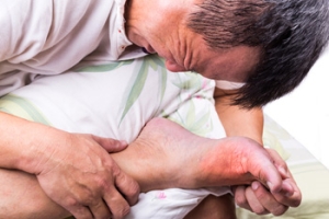 Symptoms and Causes of Gout