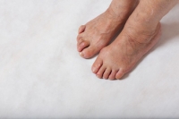 Can a Child Get a Hammertoe?