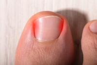 Causes and Symptoms of Ingrown Toenails